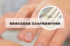 银屑病艾灸后加重 艾灸治疗银屑病疗效观察