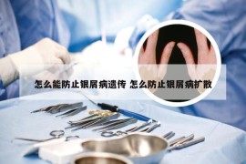 怎么能防止银屑病遗传 怎么防止银屑病扩散