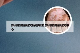 郑州银屑病研究所在哪里 郑州银屑病研究中心