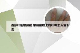 面部红色银屑病 银屑病脸上的红斑怎么消下去