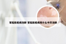 掌跖脓疱病泡脚 掌跖脓疱病用什么中药泡脚