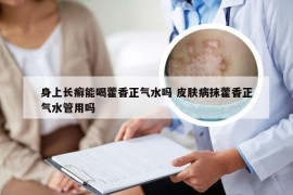 身上长癣能喝藿香正气水吗 皮肤病抹藿香正气水管用吗