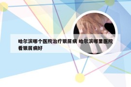 哈尔滨哪个医院治疗银屑病 哈尔滨哪里医院看银屑病好