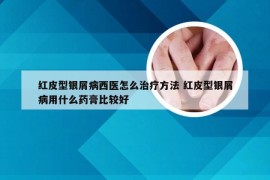 红皮型银屑病西医怎么治疗方法 红皮型银屑病用什么药膏比较好