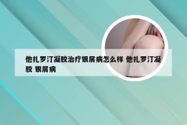 他扎罗汀凝胶治疗银屑病怎么样 他扎罗汀凝胶 银屑病