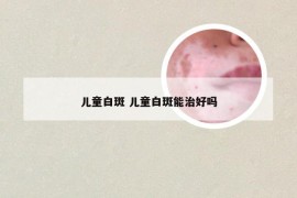 儿童白斑 儿童白斑能治好吗