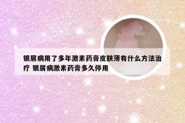 银屑病用了多年激素药膏皮肤薄有什么方法治疗 银屑病激素药膏多久停用