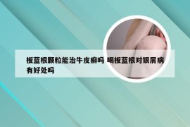 板蓝根颗粒能治牛皮癣吗 喝板蓝根对银屑病有好处吗