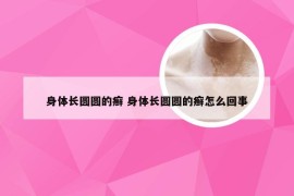 身体长圆圆的癣 身体长圆圆的癣怎么回事