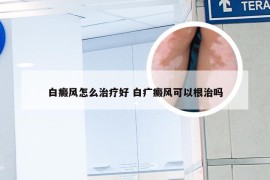 白癜风怎么治疗好 白疒癜风可以根治吗