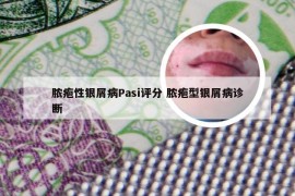 脓疱性银屑病Pasi评分 脓疱型银屑病诊断