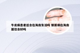 牛皮癣患者适合在海南生活吗 银屑病在海南居住会好吗