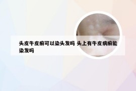 头皮牛皮癣可以染头发吗 头上有牛皮病癣能染发吗