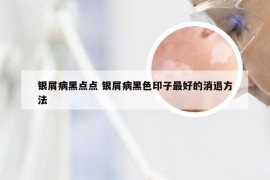 银屑病黑点点 银屑病黑色印子最好的消退方法