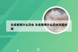 头皮癣用什么药水 头皮癣用什么药水洗最好呢