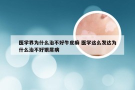 医学界为什么治不好牛皮癣 医学这么发达为什么治不好银屑病