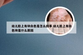 幼儿脸上有块白色是怎么回事 幼儿脸上有白色块是什么原因