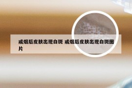 戒烟后皮肤出现白斑 戒烟后皮肤出现白斑图片