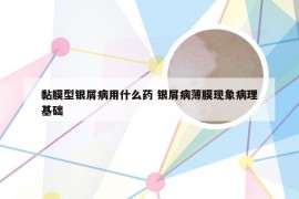 黏膜型银屑病用什么药 银屑病薄膜现象病理基础