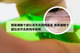 银屑病哪个部位关节炎致残率高 银屑病哪个部位关节炎致残率高呢