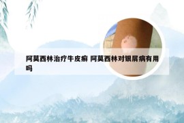 阿莫西林治疗牛皮癣 阿莫西林对银屑病有用吗