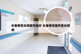 长春哪家白斑医院最好 长春哪家医院查白斑病