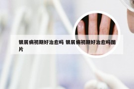 银屑病初期好治愈吗 银屑病初期好治愈吗图片