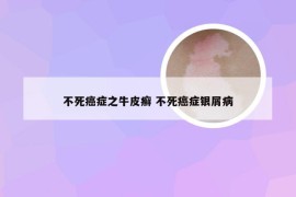 不死癌症之牛皮癣 不死癌症银屑病