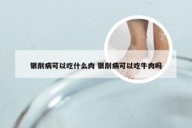 银削病可以吃什么肉 银削病可以吃牛肉吗