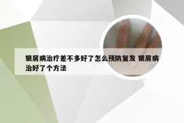 银屑病治疗差不多好了怎么预防复发 银屑病治好了个方法