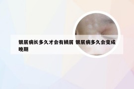 银屑病长多久才会有鳞屑 银屑病多久会变成晚期