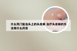 什么窍门能治头上的头皮癣 治疗头皮癣的方法用什么药膏