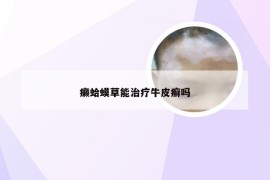 癞蛤蟆草能治疗牛皮癣吗