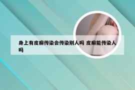 身上有皮癣传染会传染别人吗 皮癣能传染人吗