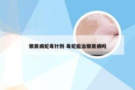 银屑病蛇毒针剂 毒蛇能治银屑病吗