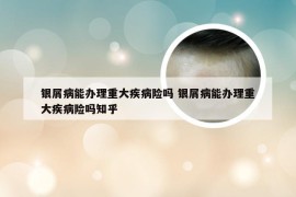 银屑病能办理重大疾病险吗 银屑病能办理重大疾病险吗知乎