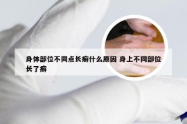 身体部位不同点长癣什么原因 身上不同部位长了癣