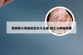 我两脚小拇指附近长什么癣 脚上小拇指两瓣