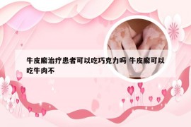 牛皮廨治疗患者可以吃巧克力吗 牛皮廨可以吃牛肉不