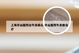 上海华山医院冶牛皮癣么 华山医院牛皮廨治疗