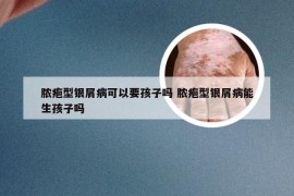 脓疱型银屑病可以要孩子吗 脓疱型银屑病能生孩子吗