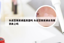 头皮型银屑病是真菌吗 头皮型银屑病会发展到身上吗