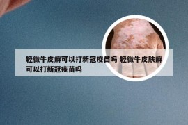 轻微牛皮癣可以打新冠疫苗吗 轻微牛皮肤癣可以打新冠疫苗吗