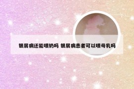 银屑病还能喂奶吗 银屑病患者可以喂母乳吗