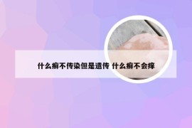 什么癣不传染但是遗传 什么癣不会痒