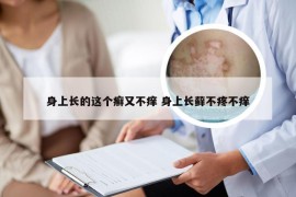 身上长的这个癣又不痒 身上长藓不疼不痒