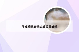 牛皮癣患者拔火罐效果好吗