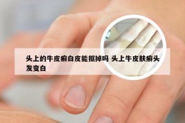 头上的牛皮癣白皮能抠掉吗 头上牛皮肤癣头发变白