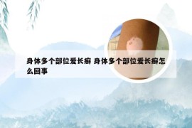 身体多个部位爱长癣 身体多个部位爱长癣怎么回事