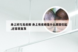 身上好几处皮癣 身上有皮癣是什么原因引起,还容易复发